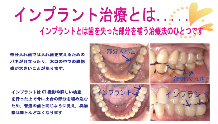 インプラント治療とは・・・インプラントとは歯を失った部分を補う治療法のひとつです　★部分入れ歯では入れ歯を支えるためのバネが目立ったり、お口の中で異物感が大きいことがあります。★インプラントはCT撮影や詳しい検査を行った上で骨に土台の部分を埋め込むため、普通の歯と同じように見え、異物感はほとんどなくなります。